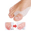1Pair Silicone Toes Separator Bunion Bone Ectropion Adjuster Toes Outer Appliance Foot Care Tools Hallux Valgus Corrector - Slobuy
