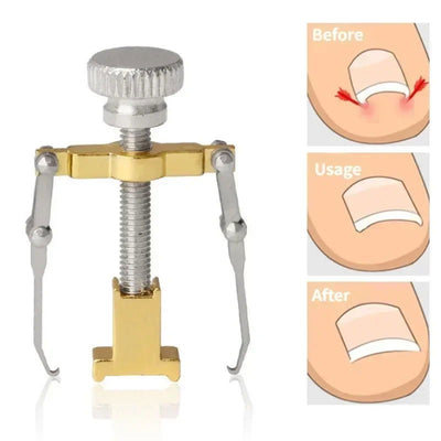 Ingrown Toenail Corrector Straightening Clip Pedicure Foot Nail Care Tools Stainless Steel Pedicure Treatment Onyxis Correction - Slobuy