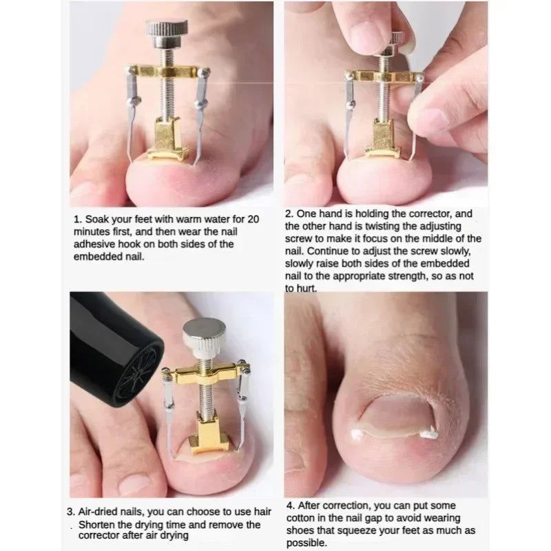 Ingrown Toenail Corrector Straightening Clip Pedicure Foot Nail Care Tools Stainless Steel Pedicure Treatment Onyxis Correction - Slobuy