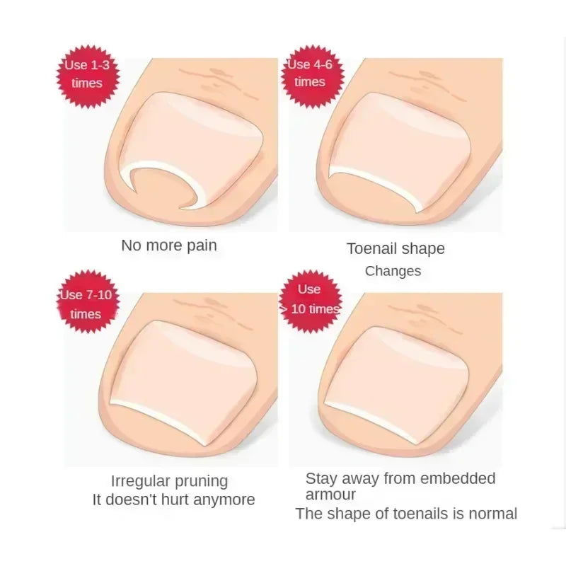 Ingrown Toenail Corrector Straightening Clip Pedicure Foot Nail Care Tools Stainless Steel Pedicure Treatment Onyxis Correction - Slobuy