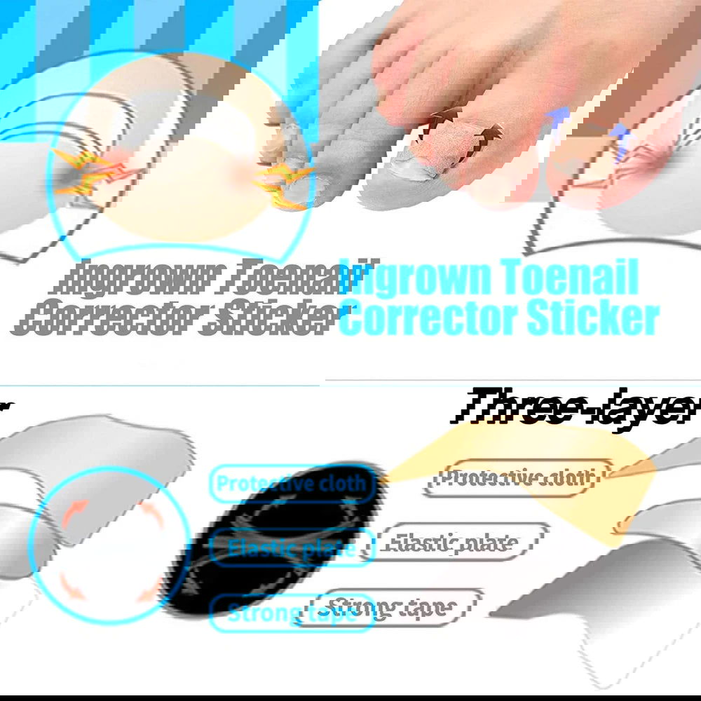 Ingrown Toenail Tools Set Ingrown Toenail Correction Patch Stickers Corrector Pedicure Tool Ingrown Toe Nail Treatment Foot Care - Slobuy