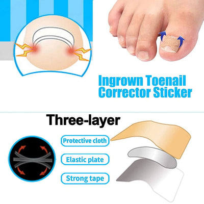 Ingrown Toenail Tools Set Ingrown Toenail Correction Patch Stickers Corrector Pedicure Tool Ingrown Toe Nail Treatment Foot Care - Slobuy