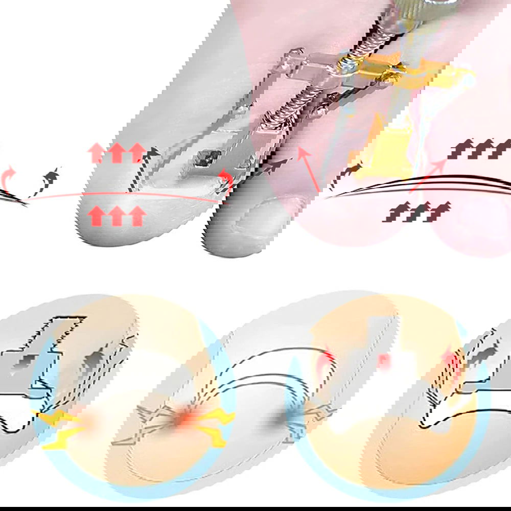 Ingrown Toenail Tools Set Ingrown Toenail Correction Patch Stickers Corrector Pedicure Tool Ingrown Toe Nail Treatment Foot Care - Slobuy