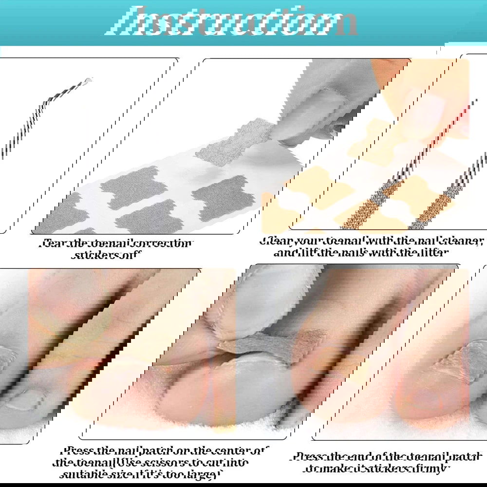 Ingrown Toenail Tools Set Ingrown Toenail Correction Patch Stickers Corrector Pedicure Tool Ingrown Toe Nail Treatment Foot Care - Slobuy