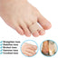Pexmen 1/2/5/10Pcs Hammer Toe Straightener Toe Splints Cushions Bandages for Correcting Crooked & Overlapping Toes Protector - Slobuy