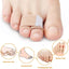Pexmen 1/2/5/10Pcs Hammer Toe Straightener Toe Splints Cushions Bandages for Correcting Crooked & Overlapping Toes Protector - Slobuy