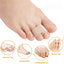 Pexmen 1/2/5/10Pcs Hammer Toe Straightener Toe Splints Cushions Bandages for Correcting Crooked & Overlapping Toes Protector - Slobuy